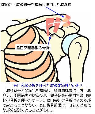 肩鎖関節脱臼の烏口突起骨折合併略図