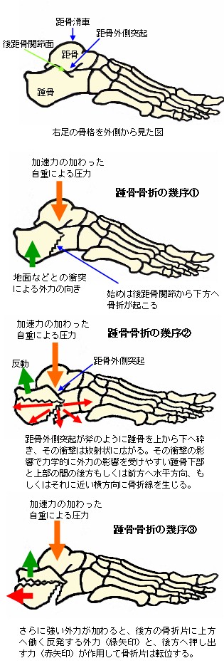 踵骨骨折の幾序