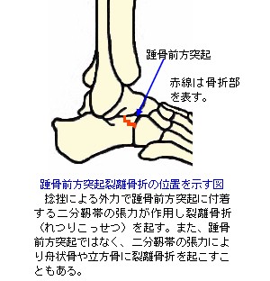 踵骨前方突起裂離骨折の位置を示す図