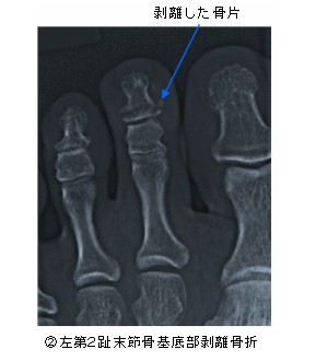第２趾末節骨基底部剥離骨折レントゲン画像