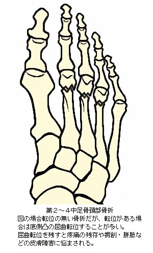第２〜４中足骨頚部骨折略図