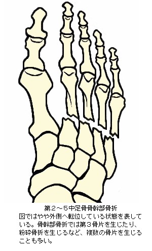 第２〜５中足骨骨幹部骨折略図