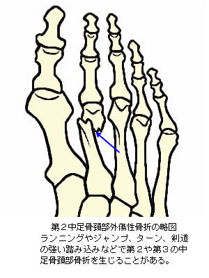 第２中足骨頚部外傷性骨折