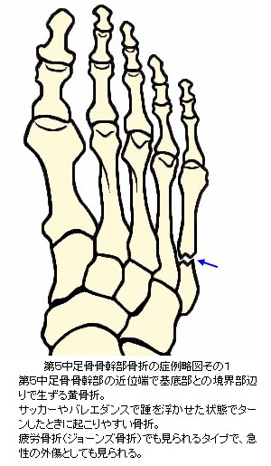 第５中足骨骨幹部骨折症例略図その１