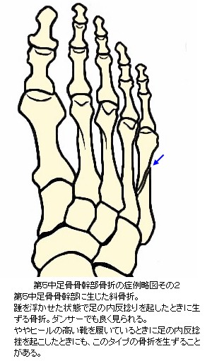 第５中足骨骨幹部骨折の症例略図その２