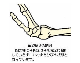 亀裂骨折の図