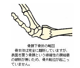 骨膜下骨折の図