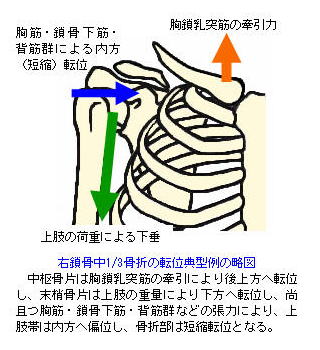 鎖骨中１／３骨折の略図