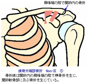 鎖骨外端部骨折Neer3-1