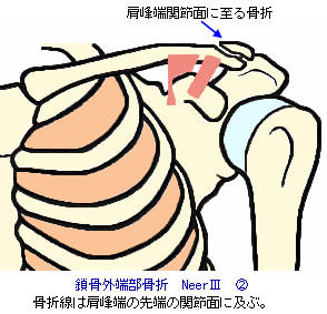 鎖骨外端部骨折Neer3-2