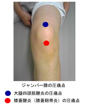 ジャンパー膝の圧痛点