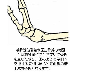 橈骨遠位端若木屈曲骨折の略図