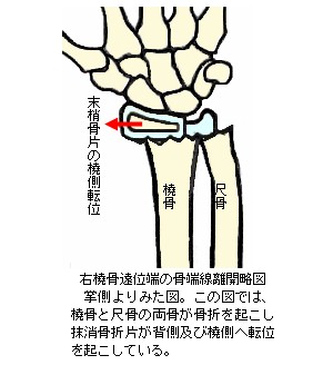 橈骨遠位端骨端線離開の略図