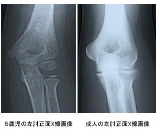 ５歳児と成人の肘関節X線画像比較