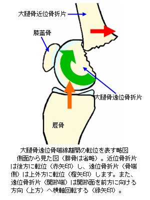 大腿骨遠位骨端線離開の転位