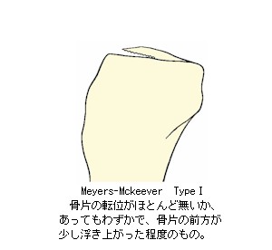 Meyers-Mckeever_Type1の解説