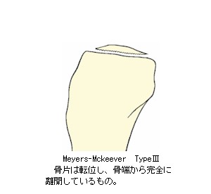 Meyers-Mckeever_Type3の解説