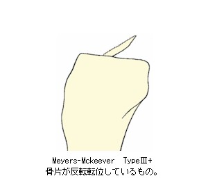 Meyers-Mckeever_Type3+の解説
