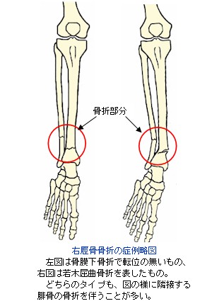 脛骨骨幹部骨折の症例略図