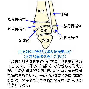 成長期の足関節X線前後像略図１