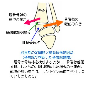 成長期の足関節X線前後像略図２〜骨端線離開１