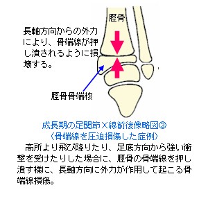 成長期の足関節X線前後像略図３〜骨端線離開２