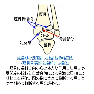 成長期の足関節X線前後像略図４〜骨端線離開３