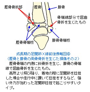 成長期の足関節X線前後像略図６〜骨端線離開５