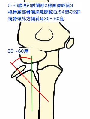 橈骨頚部骨端線離開転位の４型の２群