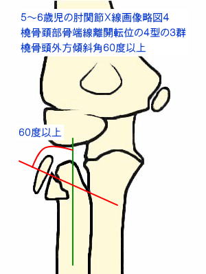 橈骨頚部骨端線離開転位の４型の３群