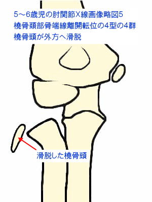 橈骨頚部骨端線離開転位の４型の４群