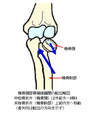 橈骨頚部骨端線離開の転位