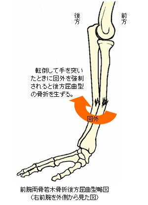 前腕骨骨幹部若木屈曲骨折後方屈曲型