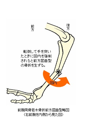 前腕骨骨幹部若木屈曲骨折前方屈曲型
