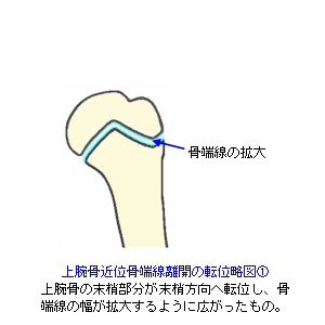 上腕骨近位端骨端線離開の転位１