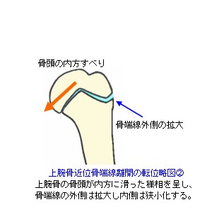 上腕骨近位端骨端線離開の転位２