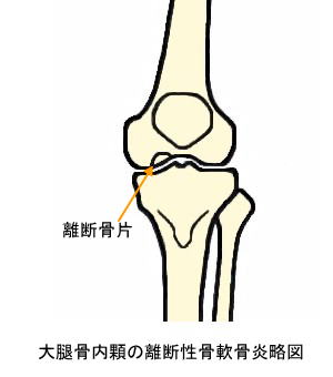 大腿骨内顆の離断性骨軟骨炎略図