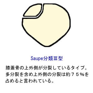 Saupe分類３型