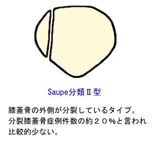 Saupe分類２型