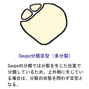 Saupe分類３型〜多分裂