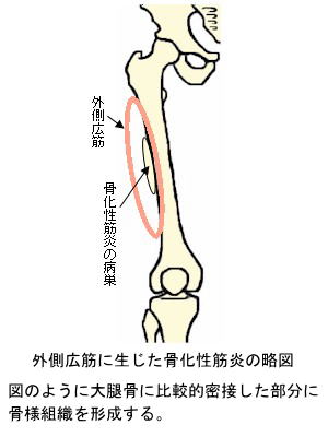 外側広筋に生じた骨化性筋炎の略図