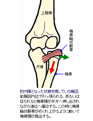 肘内障となった状態の骨格略図