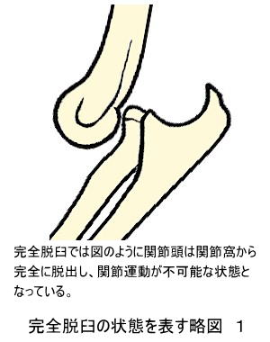 完全脱臼の状態を表す略図１