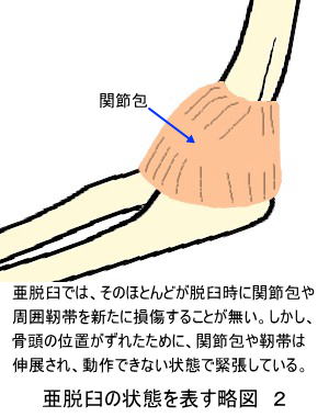 亜脱臼の状態を表す略図２