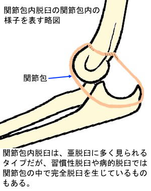 関節包内脱臼を表す略図２