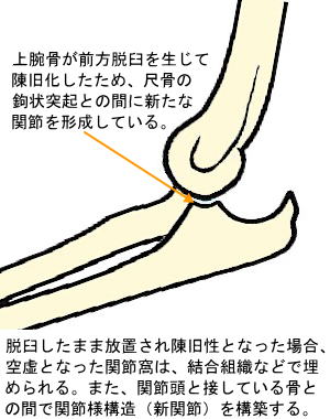 陳旧性脱臼の新関節形成を表す略図