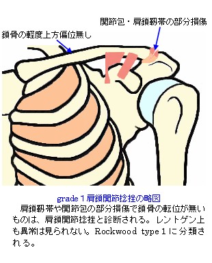 肩鎖関節捻挫の略図