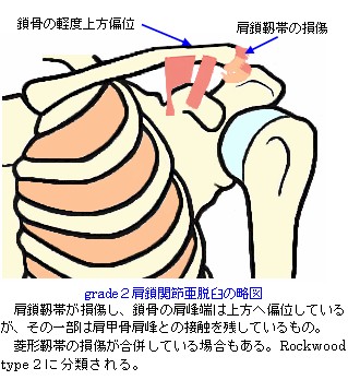 肩鎖関節亜脱臼の略図