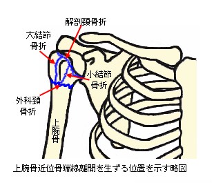 上腕骨近位骨端線離開を生ずる位置を示す略図
