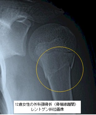 １２歳女性上腕骨外科頚骨折レントゲン画像２
